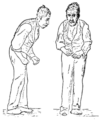 Meet Neurologist In Medanta Gurgaon For Parkinson’s Disease Treatment