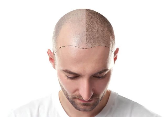 Who Is The Best Hair Transplant Surgeon In Jaipur Who Is The Best Hair Transplant Surgeon In Jaipur