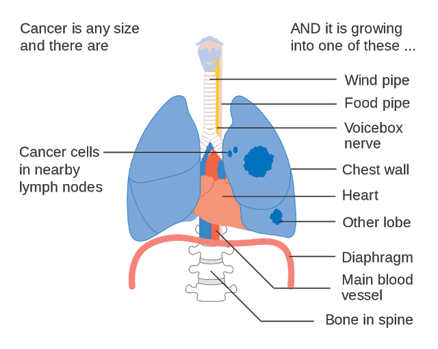 Know All About Lung Cancer Know All About Lung Cancer