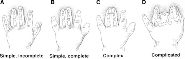 Types Of Syndactyly Disease