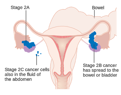 3 Types Of Ovarian Cancer Every Woman Should Know About 3 Types Of Ovarian Cancer Every Woman Should Know About