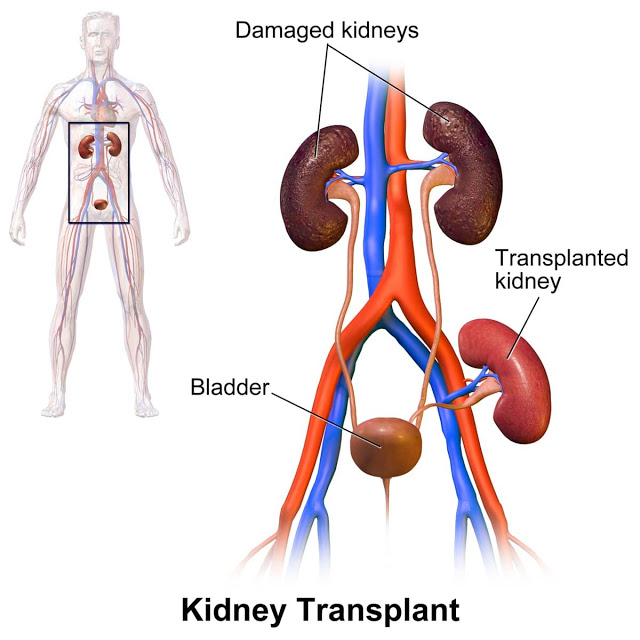 Renal Transplantation In India