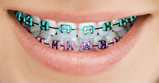 Tips During Orthodontics Invisalign Tips During Orthodontics Invisalign